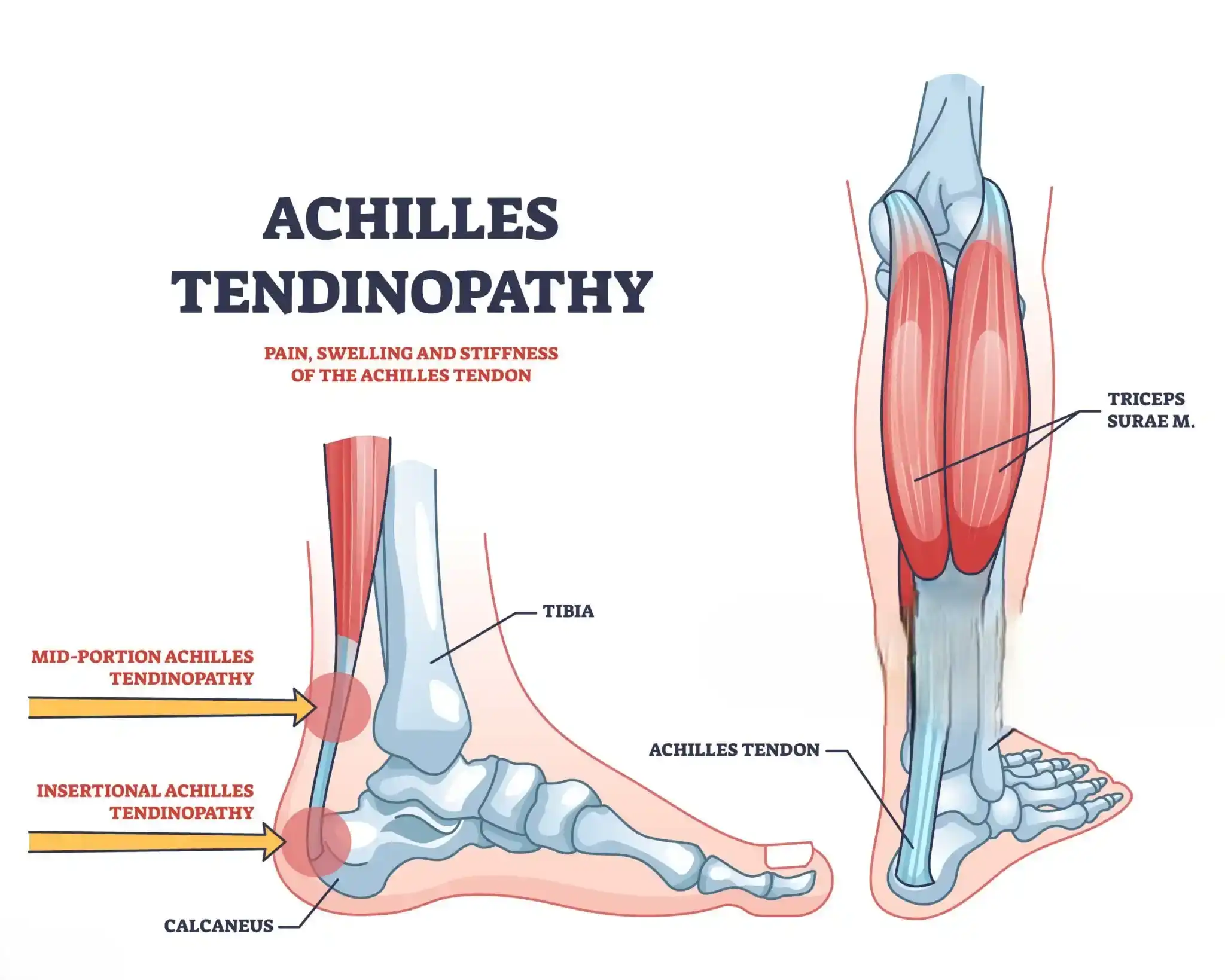 Achilles Tendinopathy