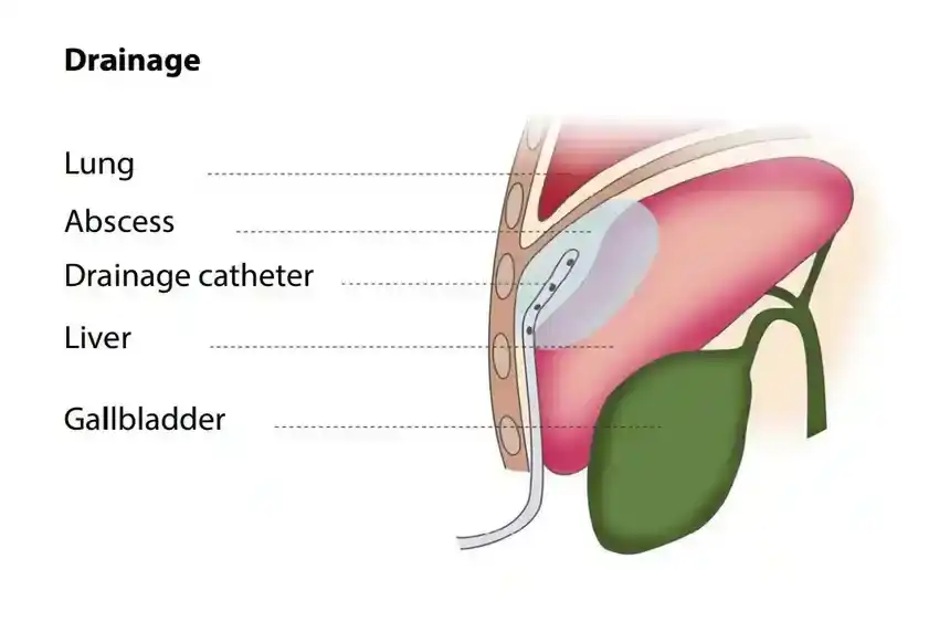 Percutaneous Drainage