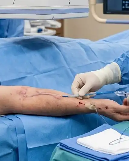 Fistuloplasty