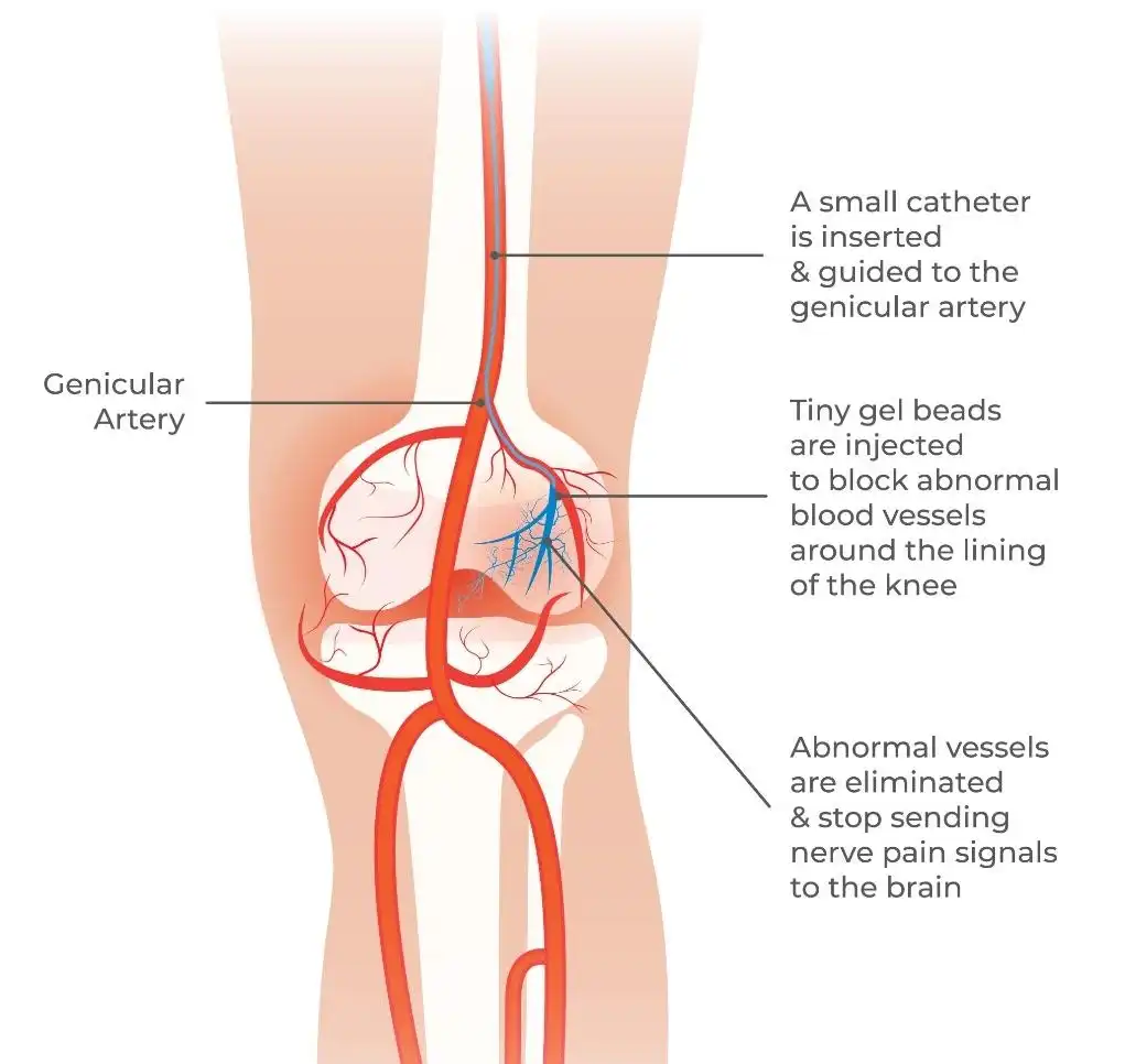 Genicular Artery Embolization (GAE)