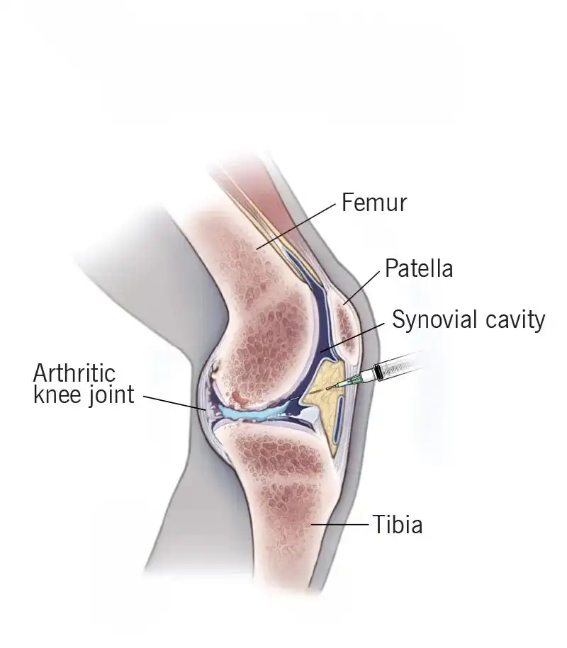 Joint Injections (PRP & Corticosteroids)