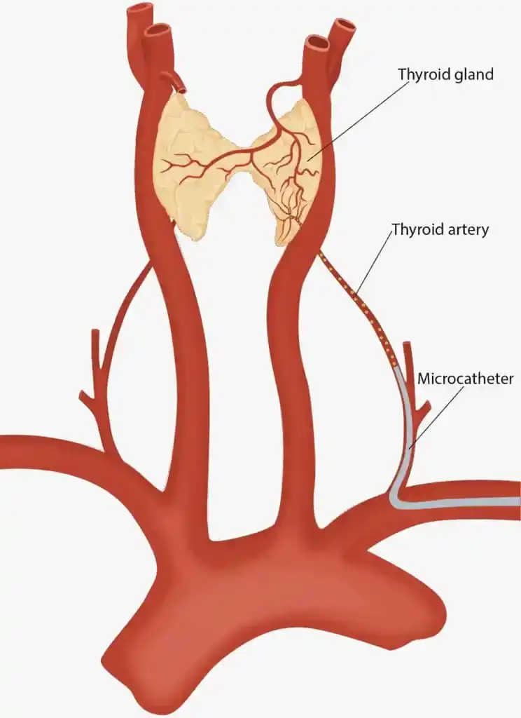 Thyroid Artery Embolization (TAE)