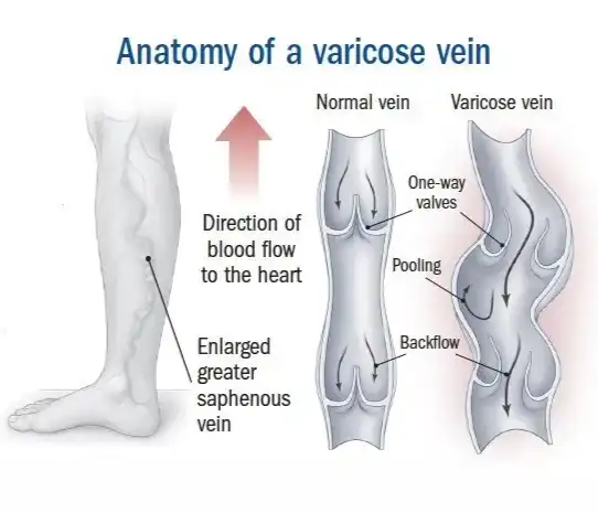 Varicose Veins Treatment