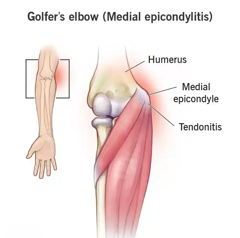 Tennis / Golfer's Elbow (TAME)