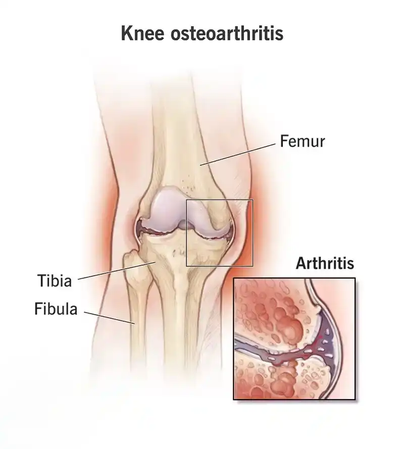 Knee Osteoarthritis (Mild–Moderate)